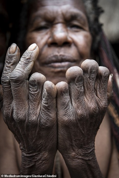 22000042-7771649-An_older_woman_shows_six_fingers_amputated_to_represent_the_loss-a-26_1575902389165.jpg